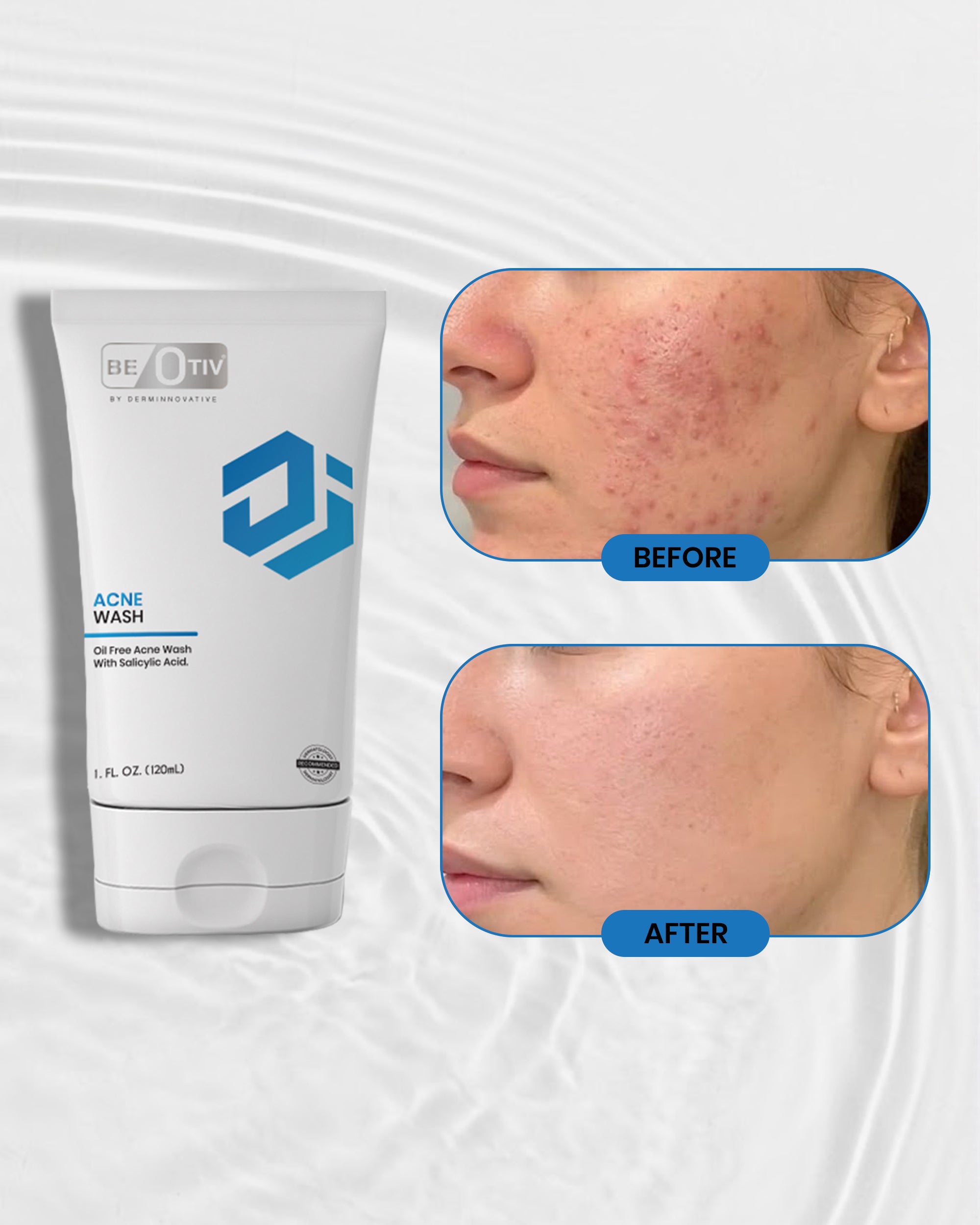 BEOTIV ACNE FACE WASH